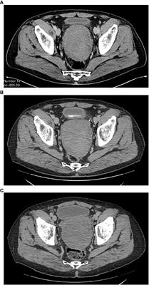 Long-term disease stability with bicalutamide in a man with aggressive angiomyxoma: case report and state of art